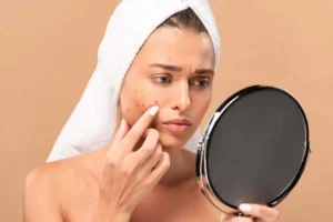 acne treatments in Niceville, FL by Blissful Beauty Bar