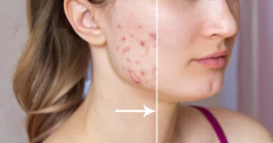 Acne Treatment Results With Improved Skin Texture And Clarity in Niceville, FL | Blissful Beauty Bar