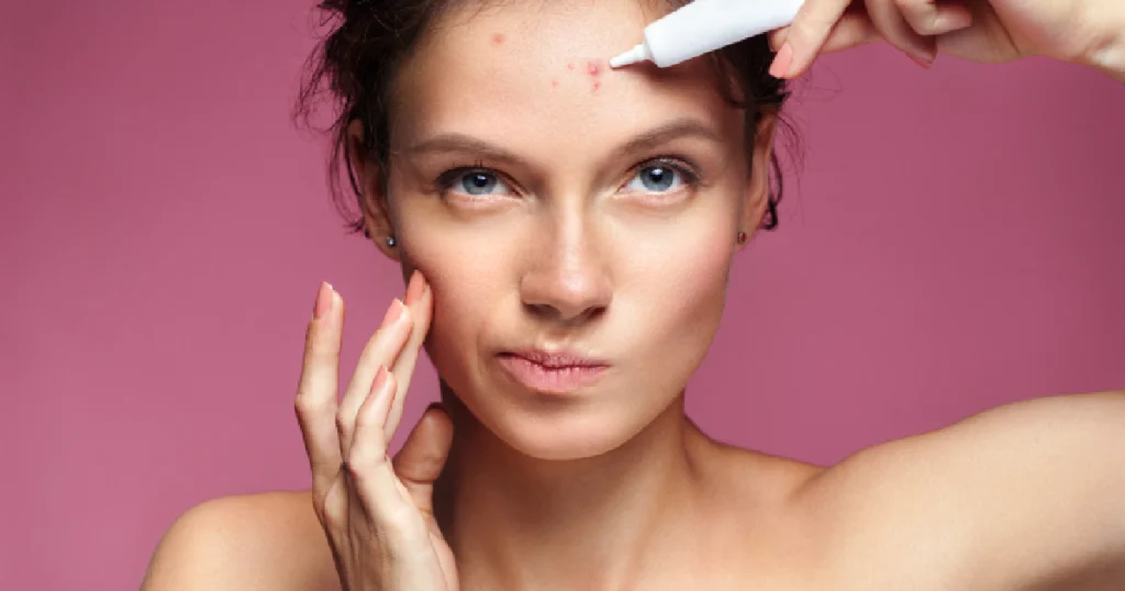 Woman Treating Facial Acne And Pimples With Skincare Product in Niceville, FL | Blissful Beauty Bar