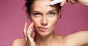 Woman Treating Facial Acne And Pimples With Skincare Product in Niceville, FL | Blissful Beauty Bar