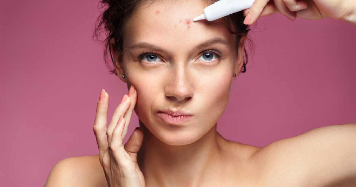 Woman Treating Facial Acne And Pimples With Skincare Product in Niceville, FL | Blissful Beauty Bar